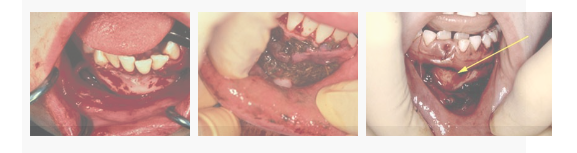 Injuries to the gingivae or oral mucosa 